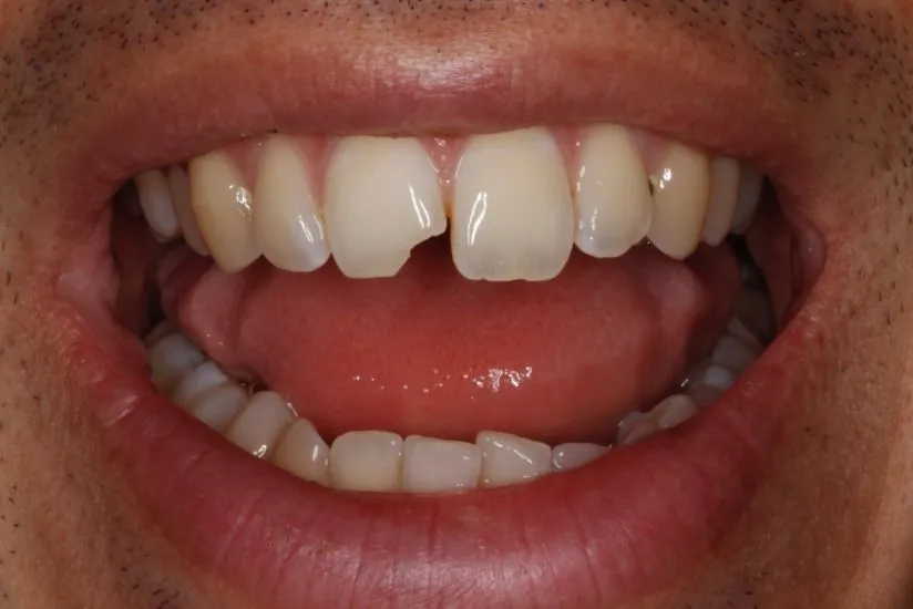 Chipped tooth Before