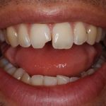 Chipped tooth Before