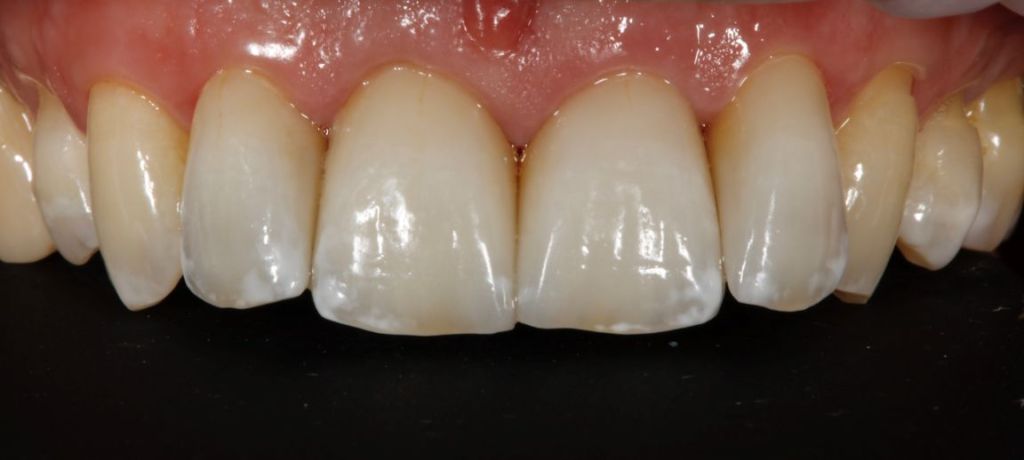 Case 5 After