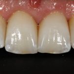Case 5 After