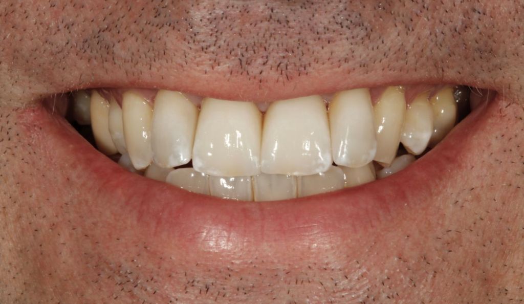 Case 4 After