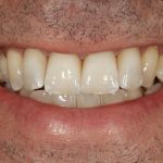 Case 4 After