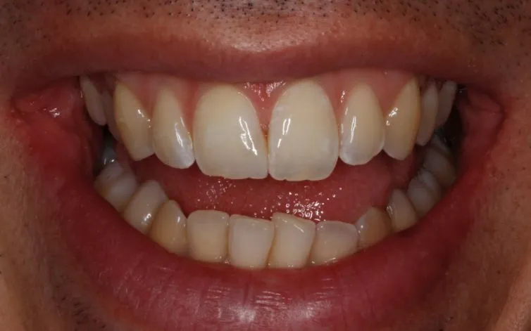 Chipped Tooth After