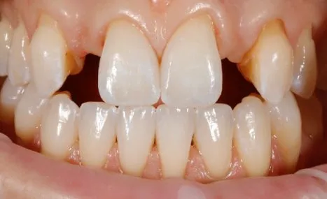 Missing Teeth Before