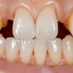 Missing Teeth Before