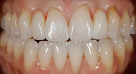 Missing Teeth After