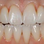 Missing Teeth After